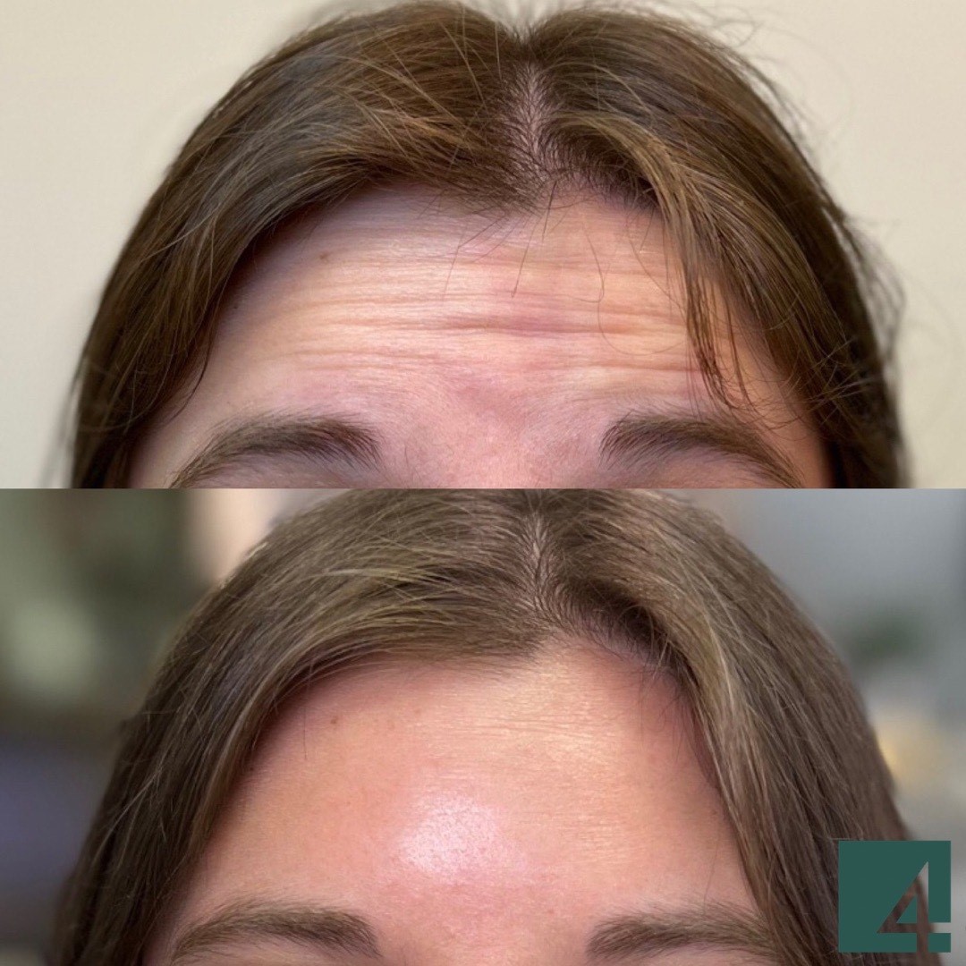 forehead line toxins before and after xeomin & dysport