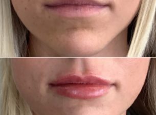 lip filler before and after