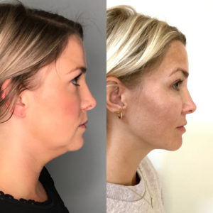 before and after Kybella