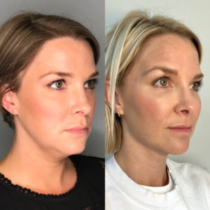 kybella before and after